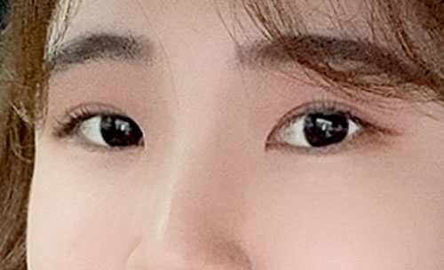 쌍꺼풀(자연유착) 후기