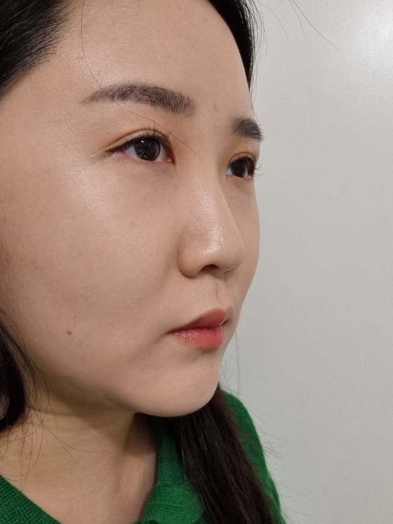 코끝(자가연골) 후기