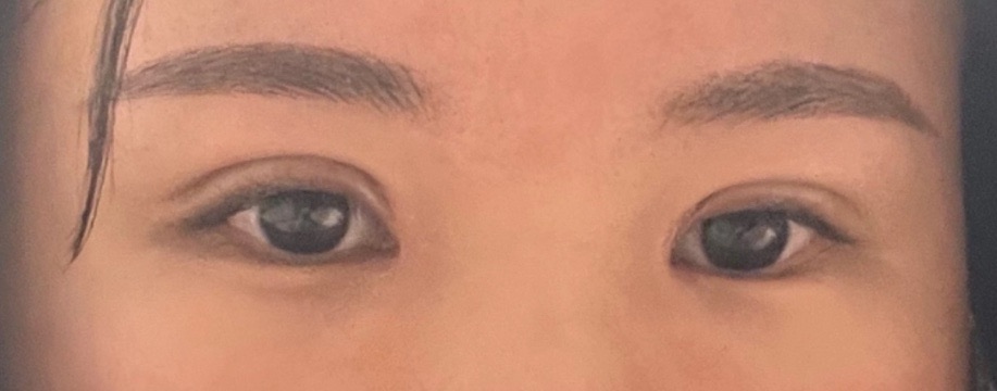 밑트임 후기