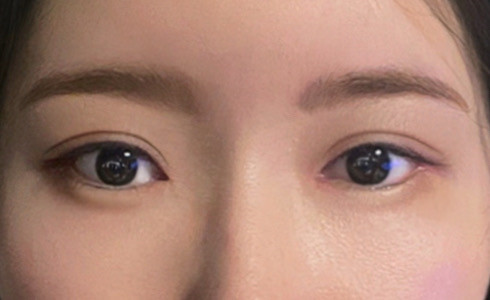 눈재수술 후기
