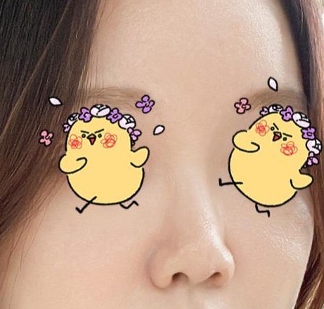 코끝(기증연골) 후기