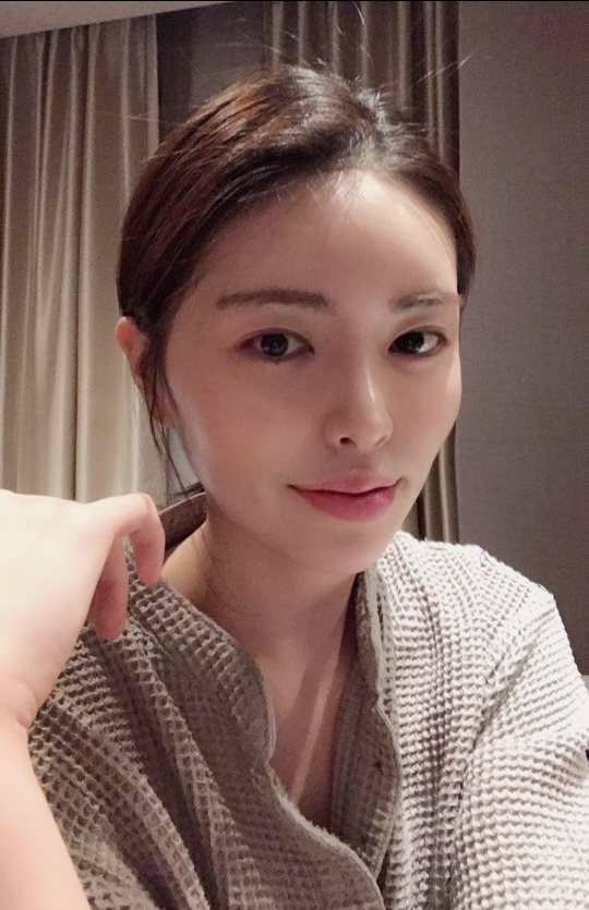 쌍꺼풀(절개) 후기