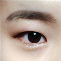 쌍꺼풀(절개) 후기