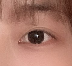 눈재수술 후기