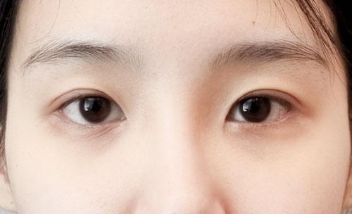 눈재수술 후기