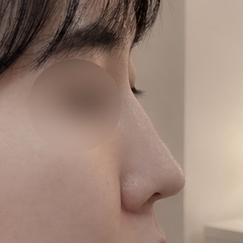 매부리코성형 후기