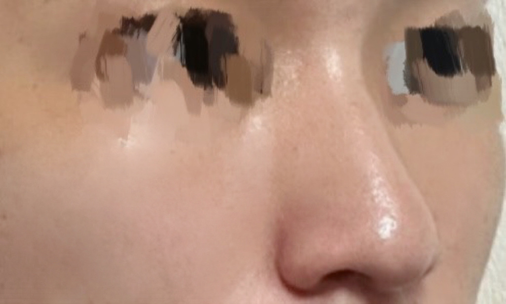 코끝(자가연골) 후기