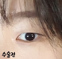쌍꺼풀(절개) 후기