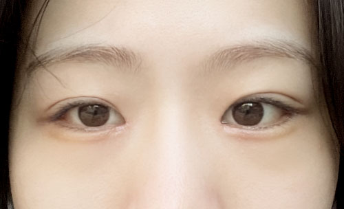 쌍꺼풀(자연유착) 후기