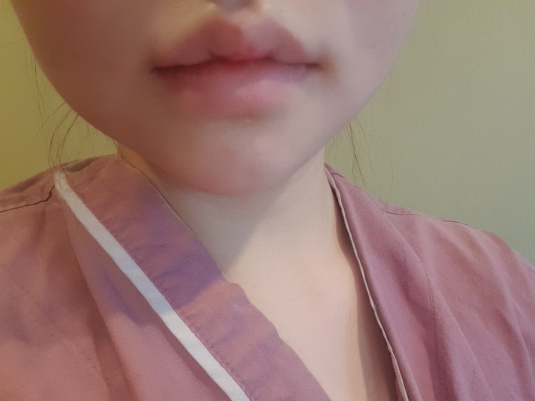 입꼬리성형 후기