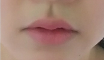 입꼬리성형 후기