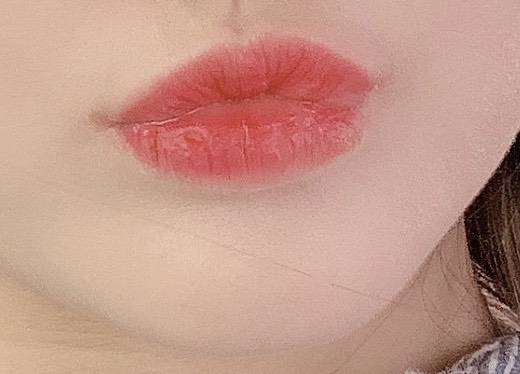 입꼬리성형 후기