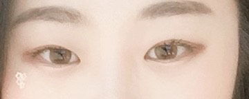 쌍꺼풀(절개) 후기