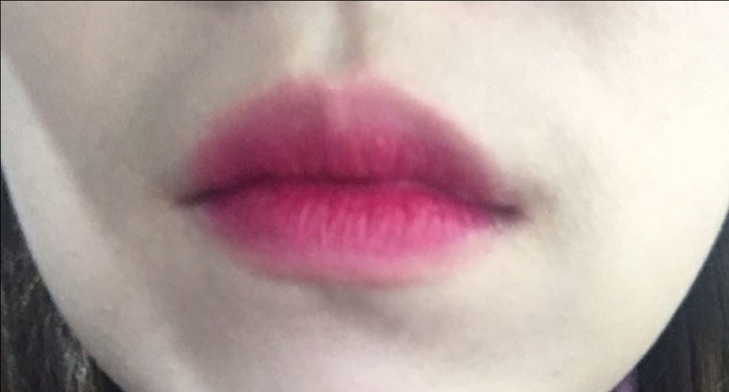 입꼬리성형 후기