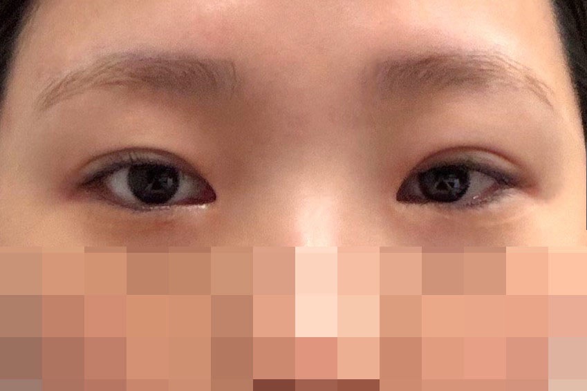 눈재수술 후기