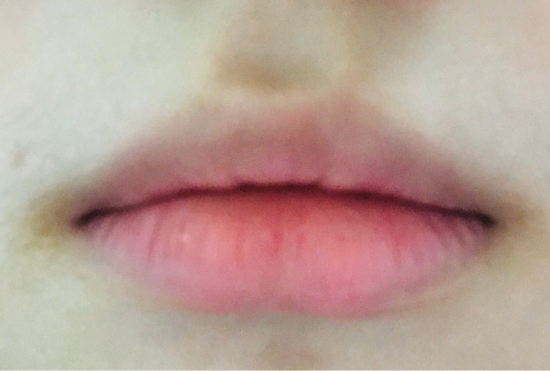 입꼬리성형 후기