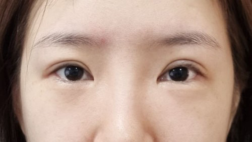 눈재수술 후기