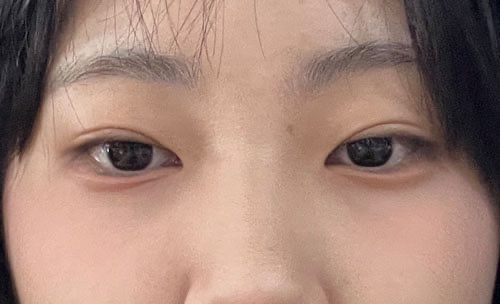 밑트임 후기