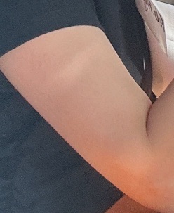 팔지방흡입 후기