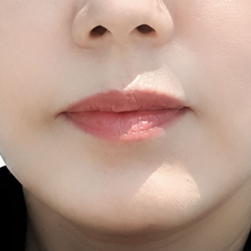 입꼬리성형 후기