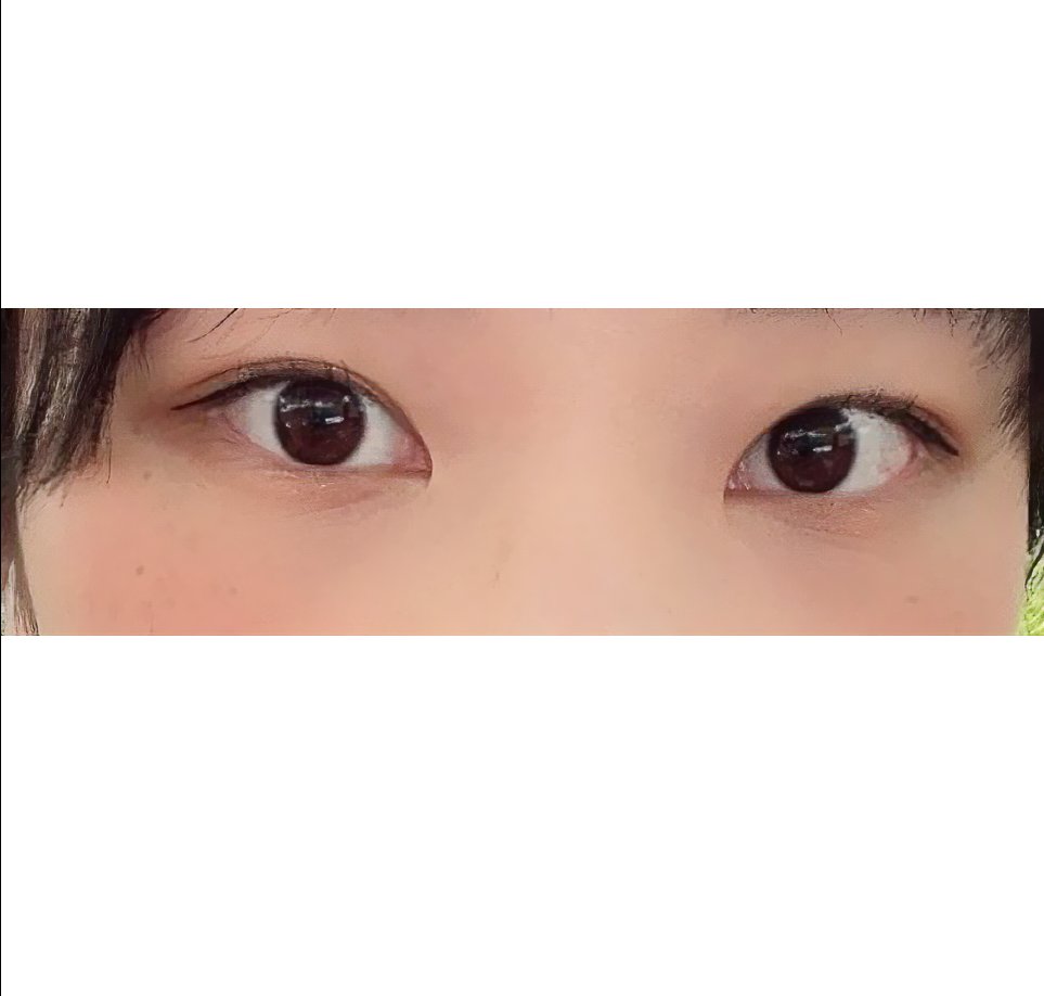 쌍꺼풀(절개) 후기