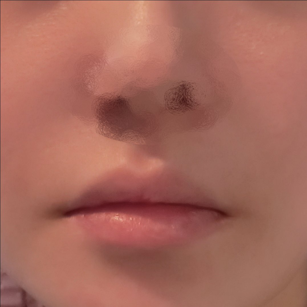 입꼬리성형 후기