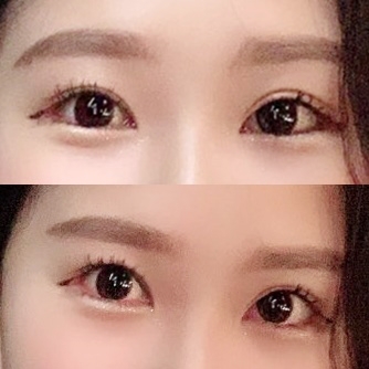 쌍꺼풀(절개) 후기