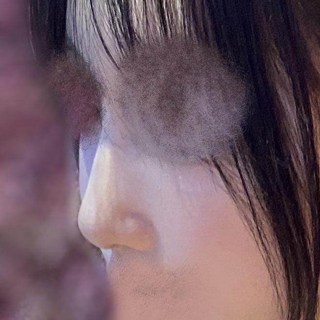 콧대(보형물) 후기
