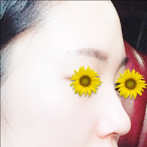 콧대(보형물) 후기