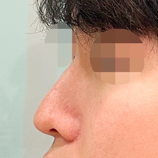 매부리코성형 후기