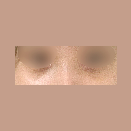 눈밑지방재배치 후기