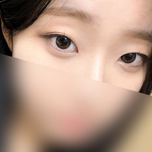 눈재수술 후기