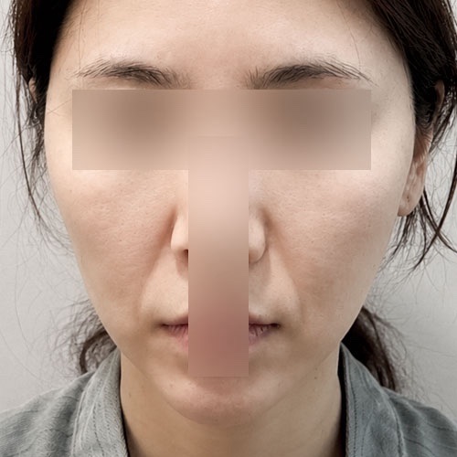 실리프팅 후기