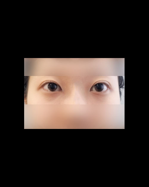 뒤트임 후기