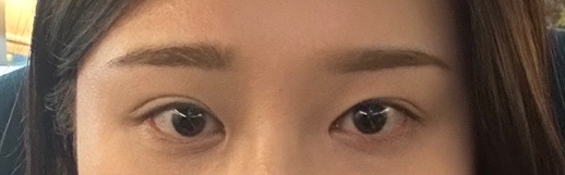 눈재수술 후기