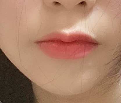입꼬리성형 후기