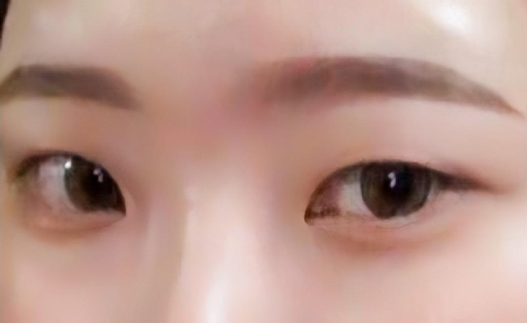 눈재수술 후기
