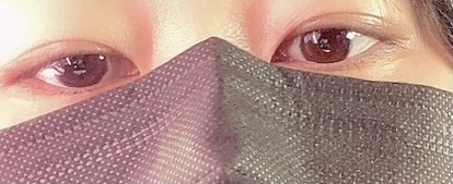 쌍꺼풀(자연유착) 후기