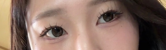 쌍꺼풀(절개) 후기