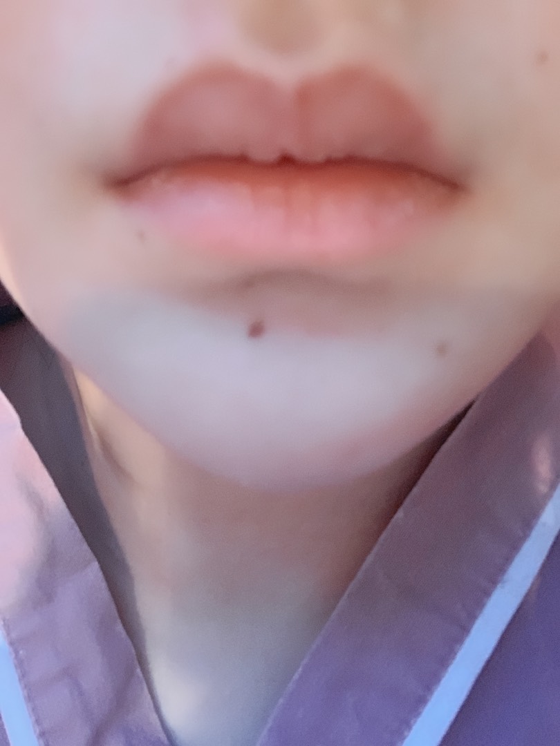 입꼬리성형 후기