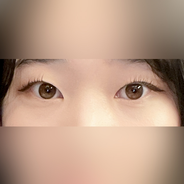 쌍꺼풀(절개) 후기