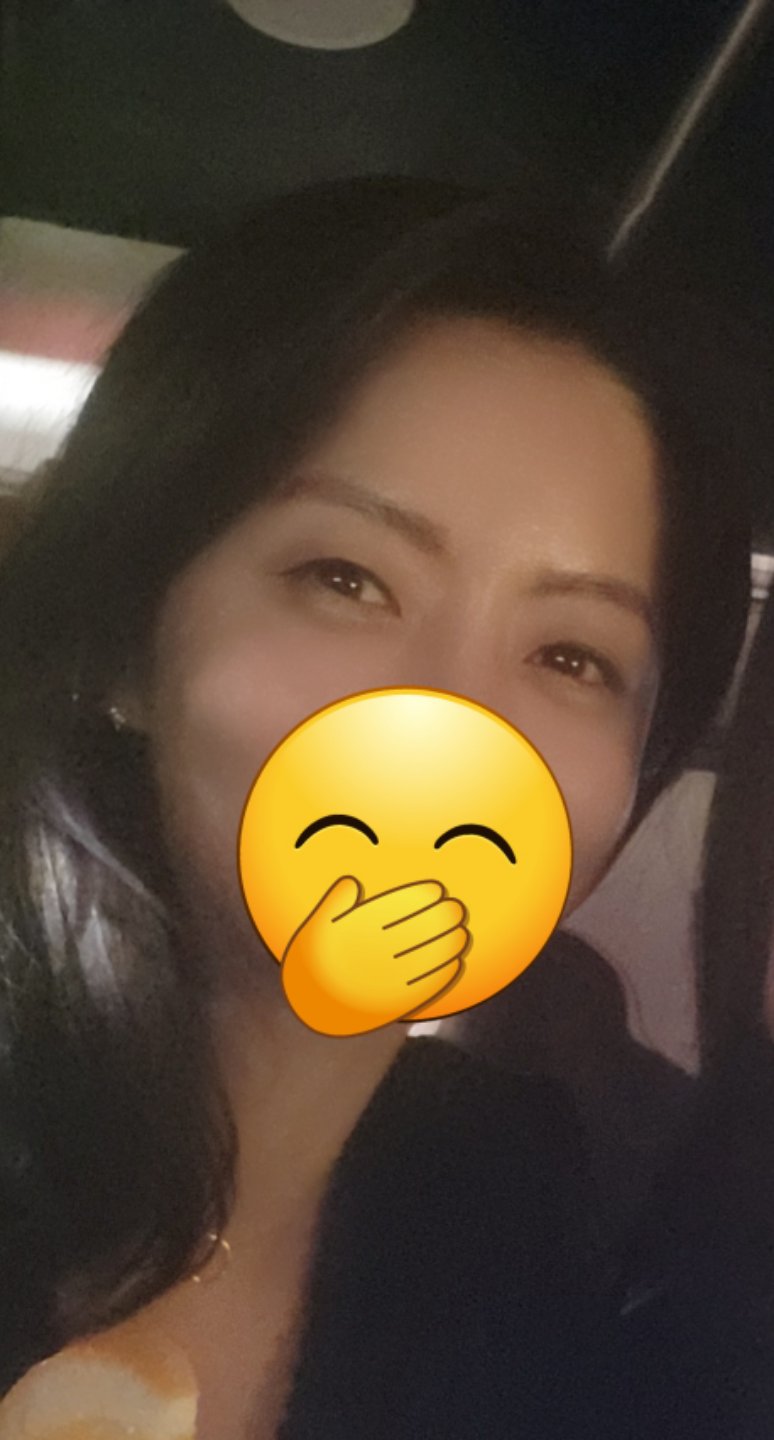 쌍꺼풀(절개) 후기