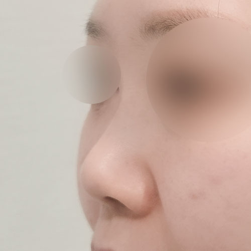 콧대(보형물) 후기