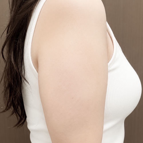 팔지방흡입 후기