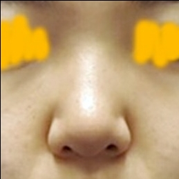 콧대(보형물) 후기