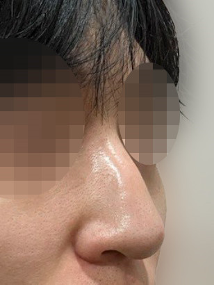 코절골술 후기