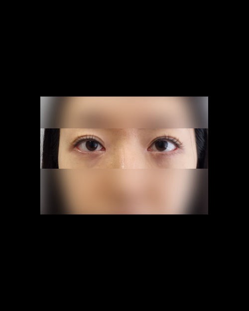 눈재수술 후기