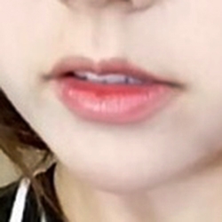 입꼬리성형 후기