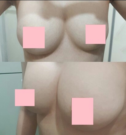 가슴재수술 후기