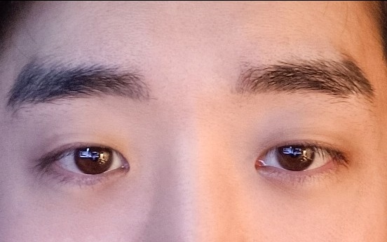 앞트임 후기